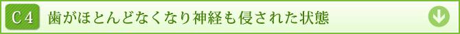 C4　歯がほとんどなくなり神経も侵された状態